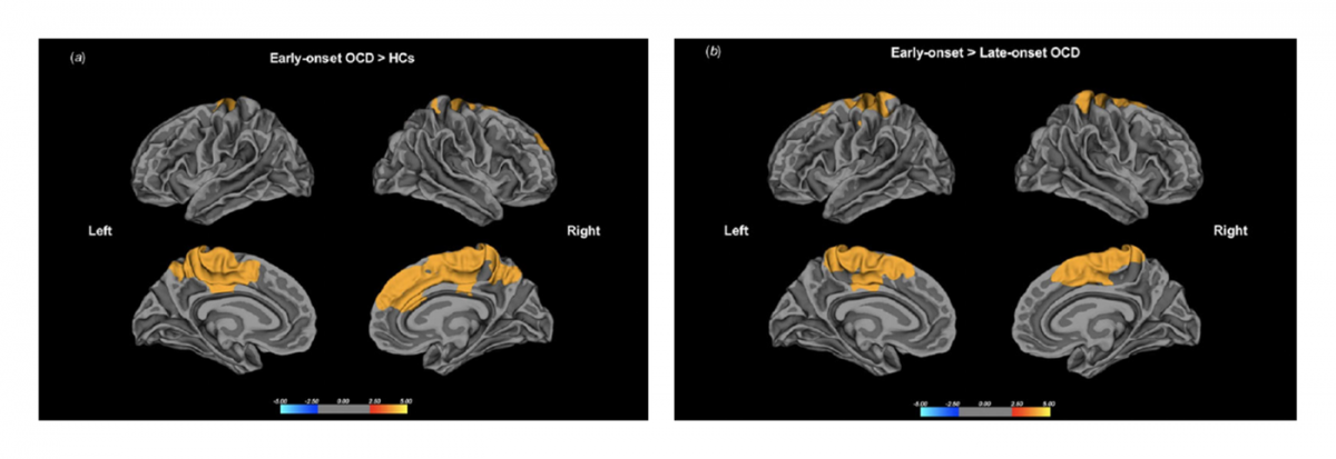 Cortical gyrification in early-onset and late-onset OCD